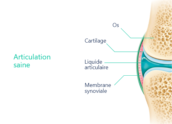 polyarthrite rhumatoïde
